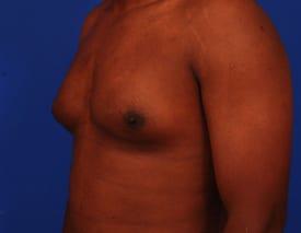 Gynecomastia Surgery Before & After Image