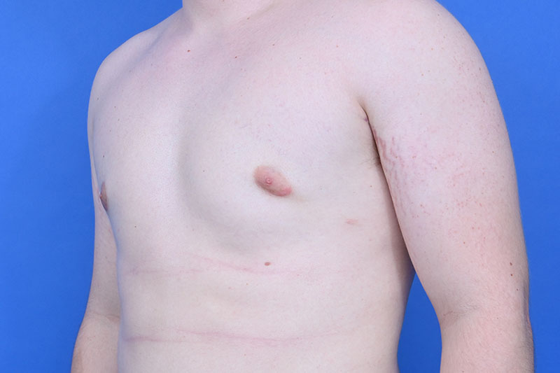 Gynecomastia Surgery Before & After Image