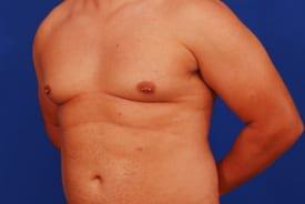 Gynecomastia Surgery Before & After Image