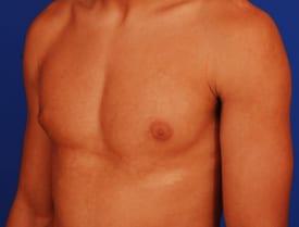 Gynecomastia Surgery Before & After Image