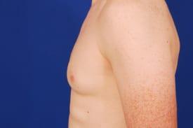 Gynecomastia Surgery Before & After Image