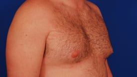 Gynecomastia Surgery Before & After Image