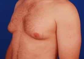 Gynecomastia Surgery Before & After Image