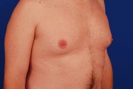 Gynecomastia Surgery Before & After Image