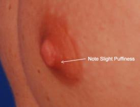 Gynecomastia Surgery Before & After Image