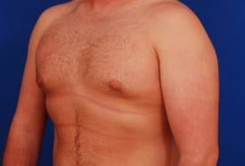 Gynecomastia Surgery Before & After Image