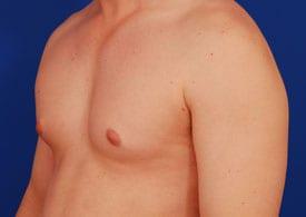 Gynecomastia Surgery Before & After Image