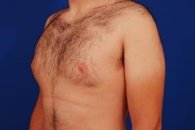 Gynecomastia Surgery Before & After Image