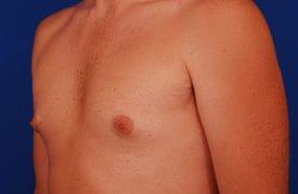 Gynecomastia Surgery Before & After Image