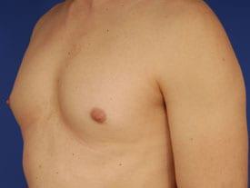 Gynecomastia Surgery Before & After Image