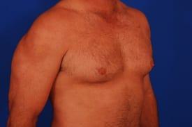 Gynecomastia Surgery Before & After Image