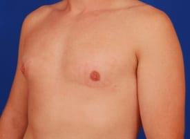 Gynecomastia Surgery Before & After Image