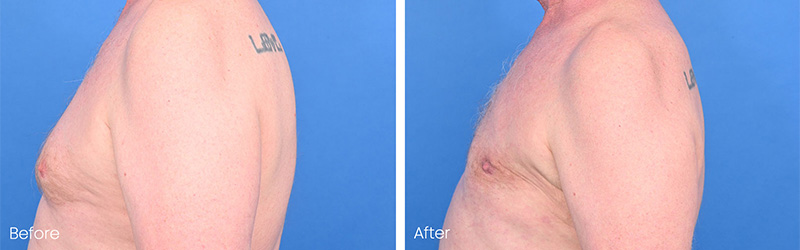 After gynecomastia surgery result with minimal scarring