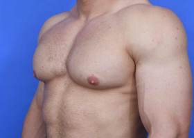 Austin Gynecomastia Surgery Before