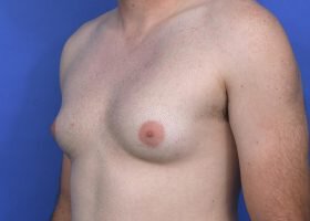 Austin Gynecomastia Surgery patient Before