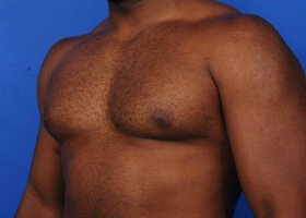 Austin Gynecomastia Surgery patient Before