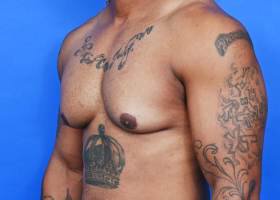 Austin Gynecomastia Surgery patient Before