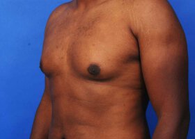 Austin Gynecomastia Surgery patient Before