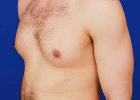 Austin Gynecomastia Surgery patient Before