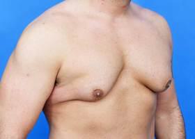 Revision Gynecomastia Surgery Before & After Image