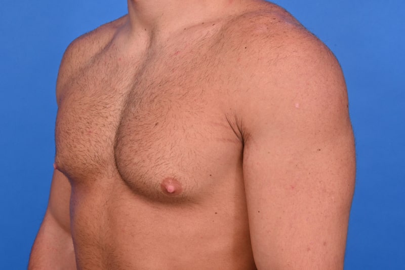Gynecomastia Surgery Before & After Image