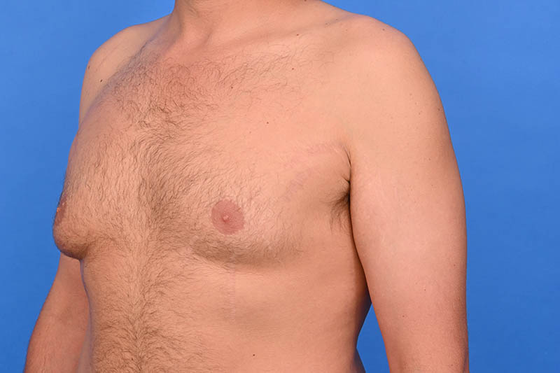 Gynecomastia Surgery Before & After Image