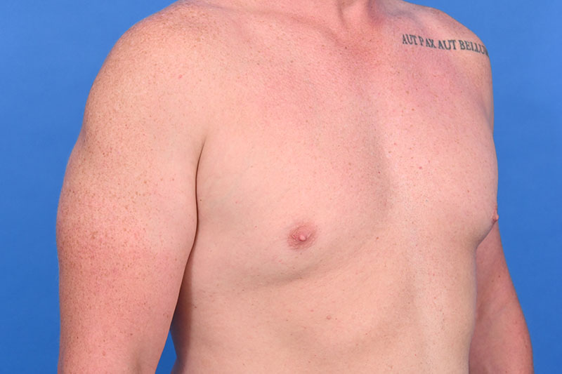 Gynecomastia Surgery Before & After Image