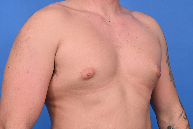 Gynecomastia Surgery Before & After Image