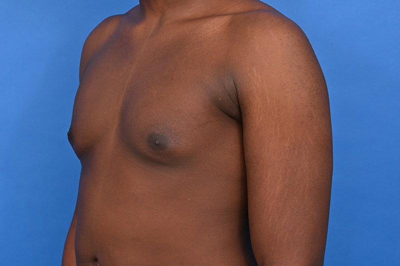 Gynecomastia Surgery Before & After Image