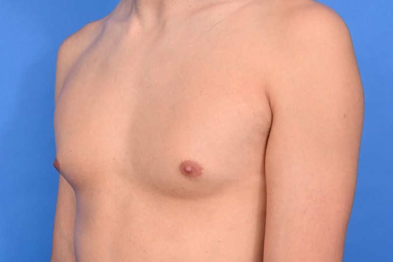 Gynecomastia Surgery Before & After Image