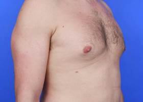 Revision Gynecomastia Surgery Before & After Image