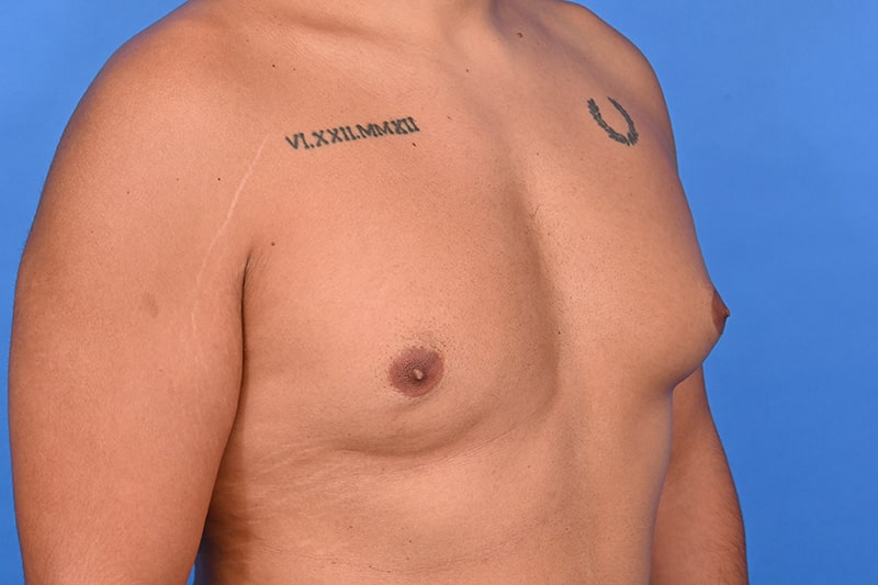 Gynecomastia Surgery Before & After Image