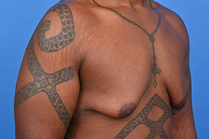 Gynecomastia Surgery Before & After Image