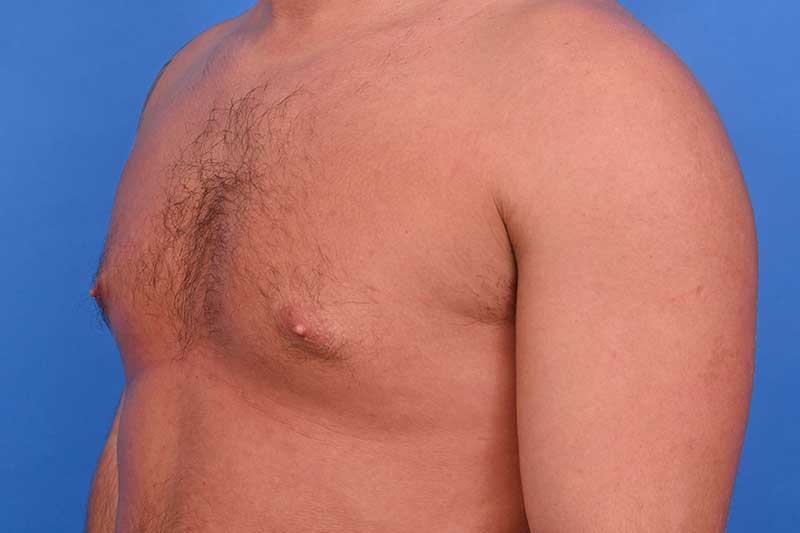 Gynecomastia Surgery Before & After Image