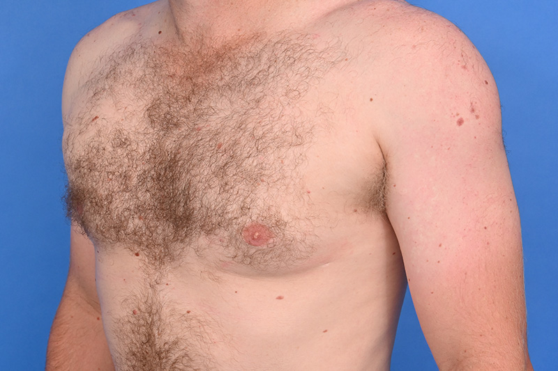 Gynecomastia Surgery Before & After Image