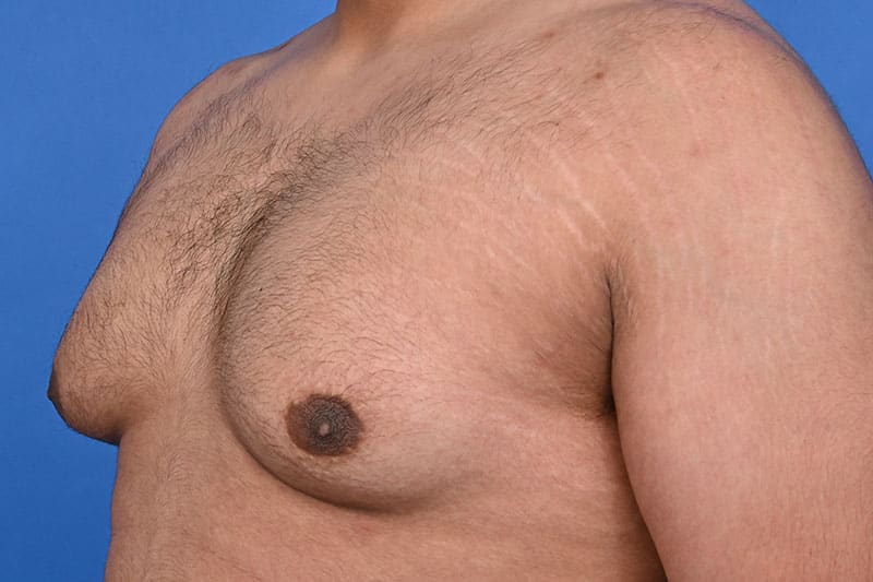 Gynecomastia Surgery Before & After Image