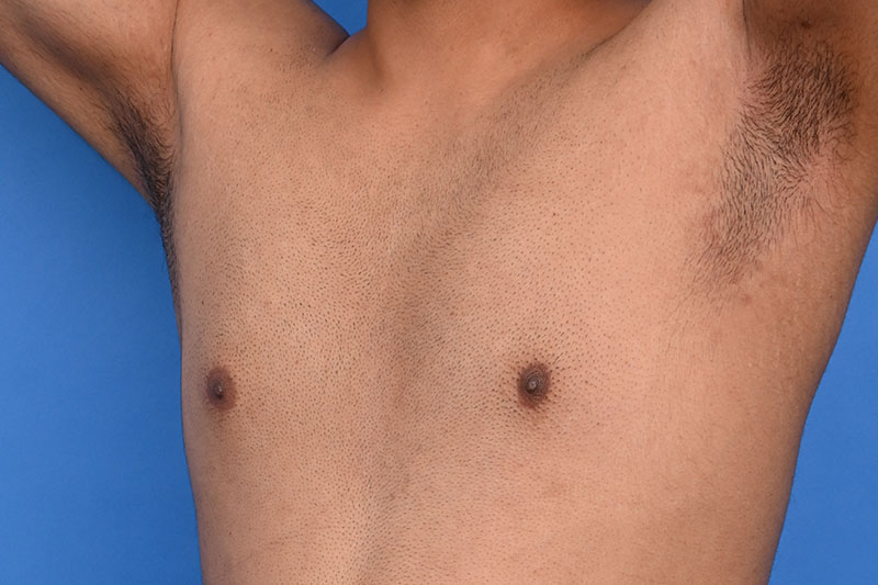 Gynecomastia Surgery Before & After Image
