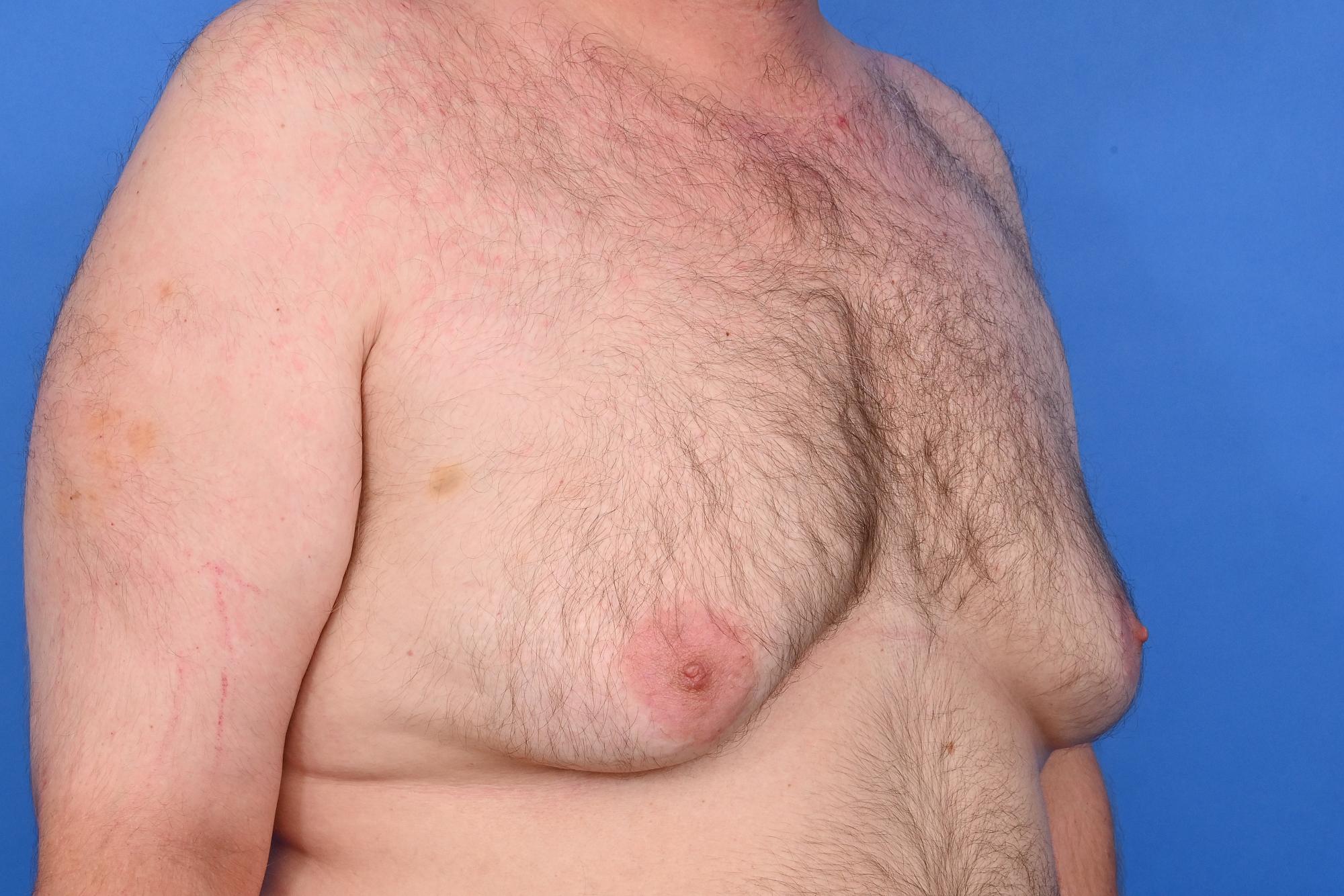 Gynecomastia Surgery Before & After Image