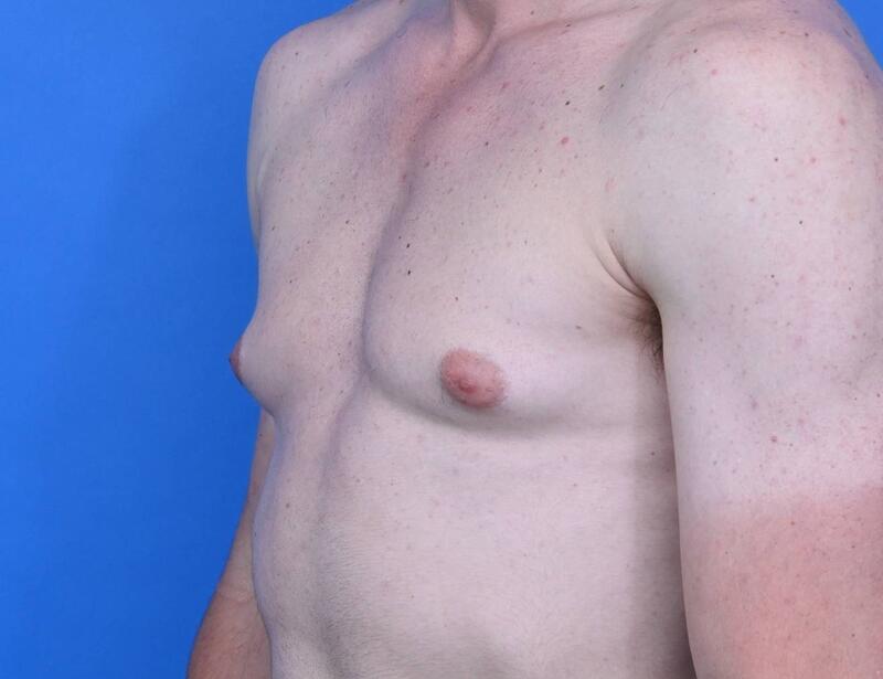 Gynecomastia Surgery Before & After Image