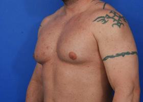 Revision Gynecomastia Surgery Before & After Image