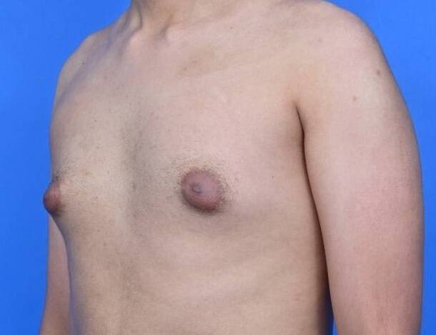 Gynecomastia Surgery Before & After Image