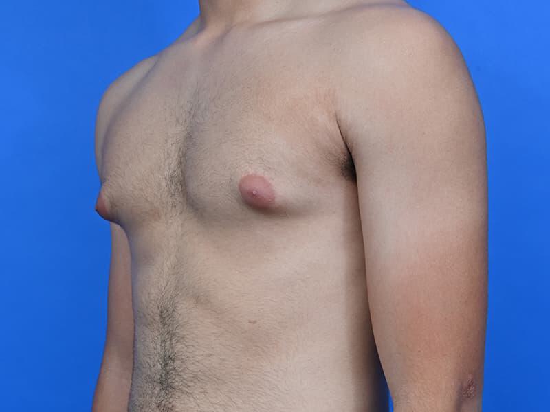 Gynecomastia Surgery Before & After Image
