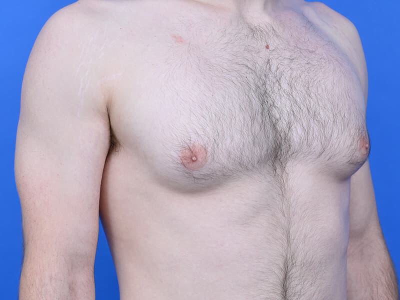 Gynecomastia Surgery Before & After Image