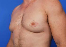 Revision Gynecomastia Surgery Before & After Image