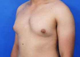 Gynecomastia Surgery Before & After Image