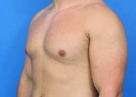 Gynecomastia Surgery Before & After Image