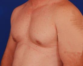 Revision Gynecomastia Surgery Before & After Image