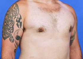Gynecomastia Surgery Before & After Image