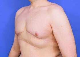 Gynecomastia Surgery Before & After Image