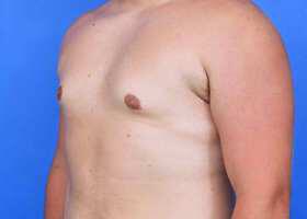 Gynecomastia Surgery Before & After Image